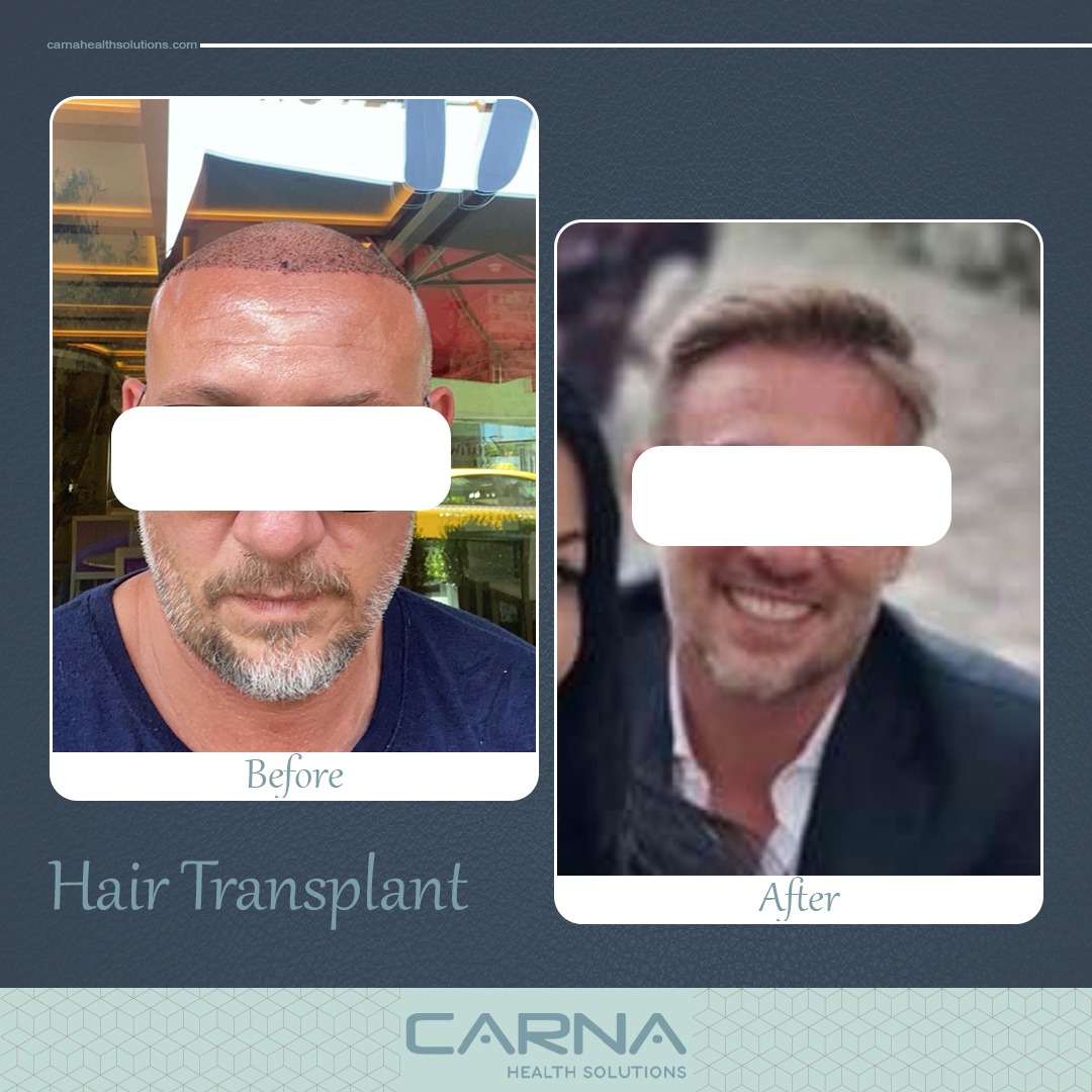 Hair Transplant