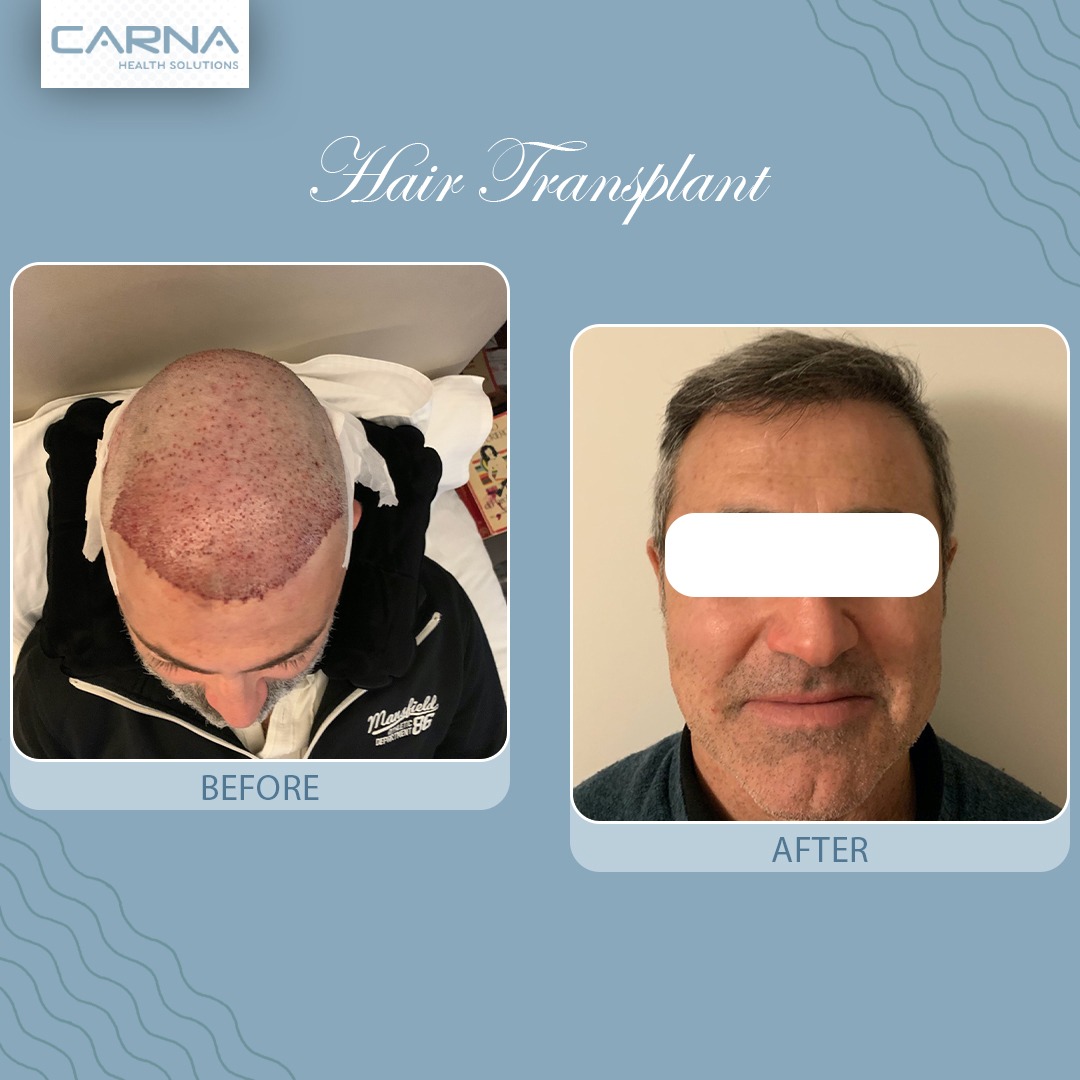 Hair Transplant