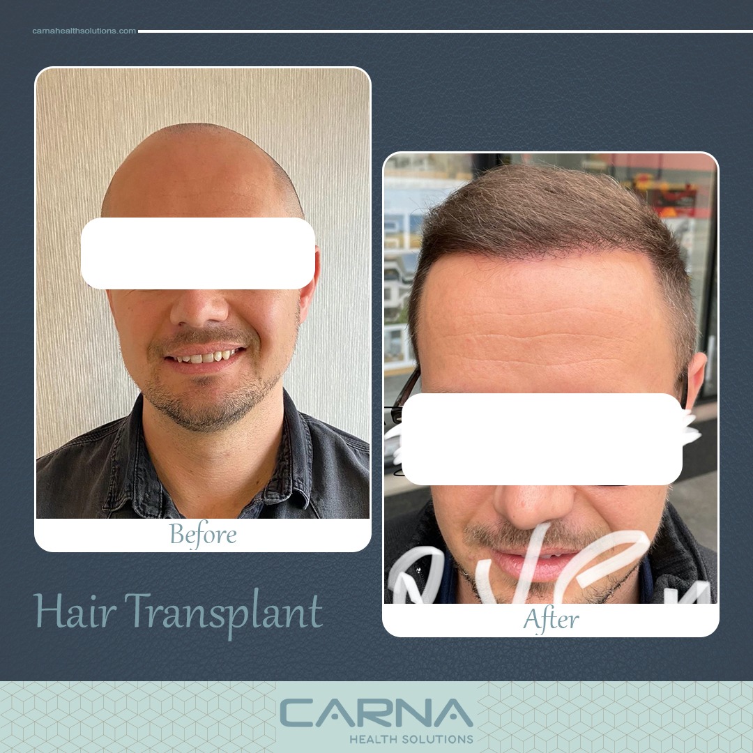 Hair Transplant