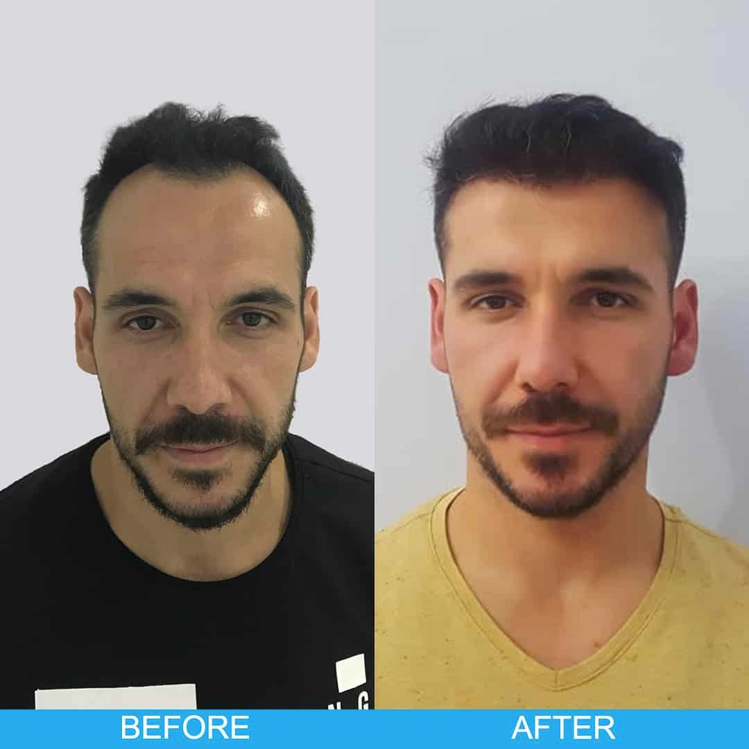 Hair Transplant